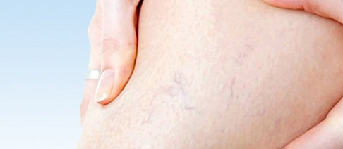 Извитость внутренней сонной артерии