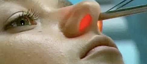 Лазер при ЛОР болезнях