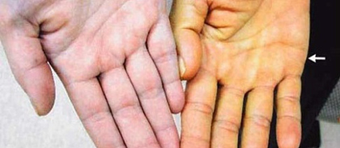 Синдром Жильбера