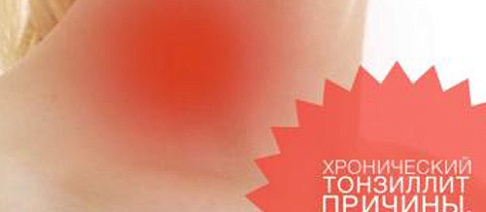 Тонзиллит
